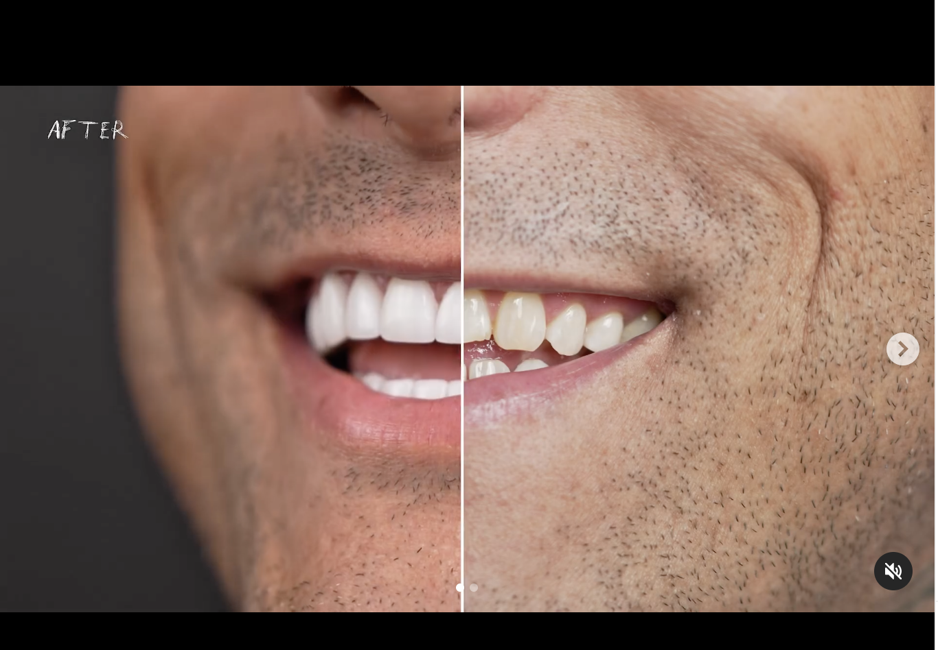 Dental Veneers